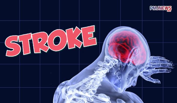 Bahaya Stroke Akibat Pecah Aneurisma Otak