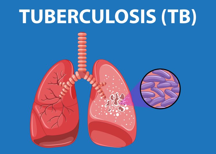 Kasus TBC Tinggi Karena Perbaikan Sistem Deteksi dan Pelaporan