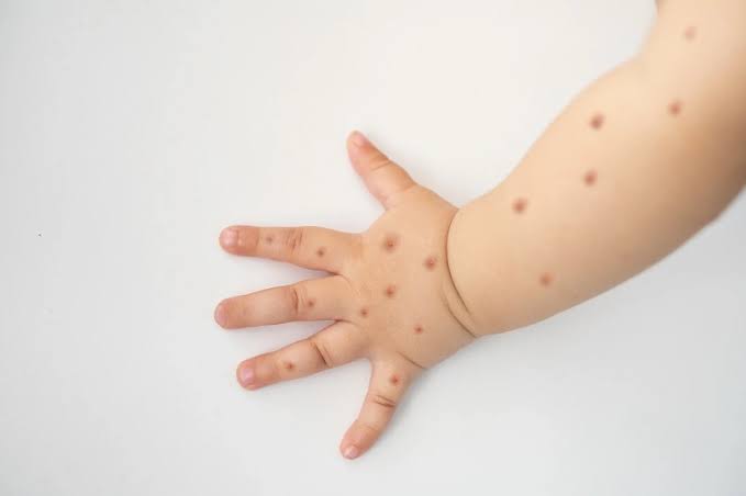 Dinkes: Kasus Flu Singapura Zero di Provinsi Sumut