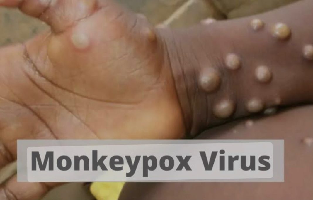 Wabah MPox di Nias Hoak